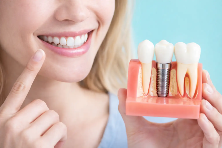 PRF implants helps heal implants faster