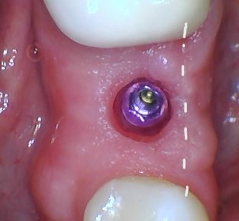 Cómo los dentistas manejan el tejido