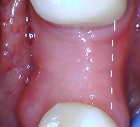 How Dentists Manage the Tissue
