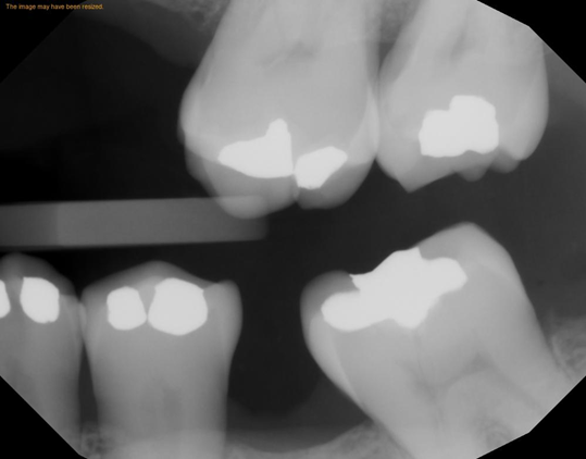 prosthetically-driven implant placement