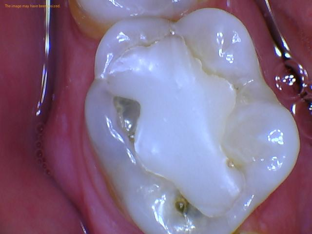 DEFECTIVE COMPOSITE RESTORATION