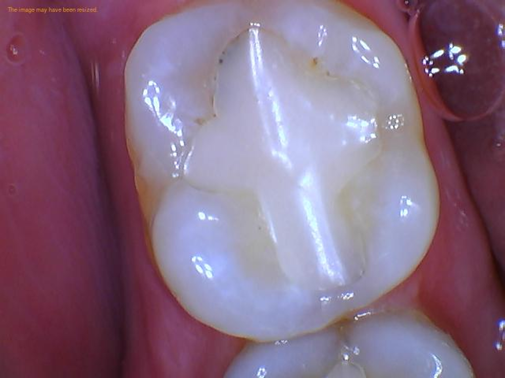 DEFECTIVE COMPOSITE RESTORATION