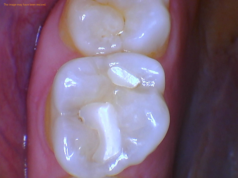 DEFECTIVE COMPOSITE RESTORATION